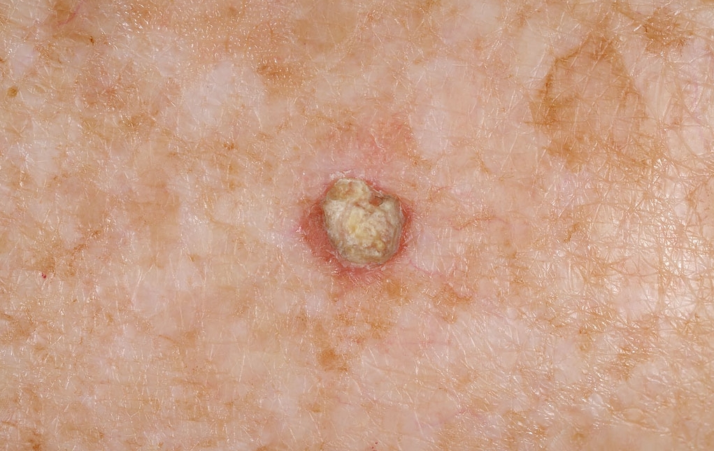 Actinic keratosis - Wikipedia