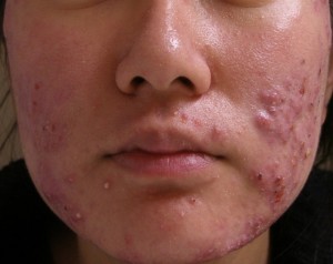 Roanoke Acne Help