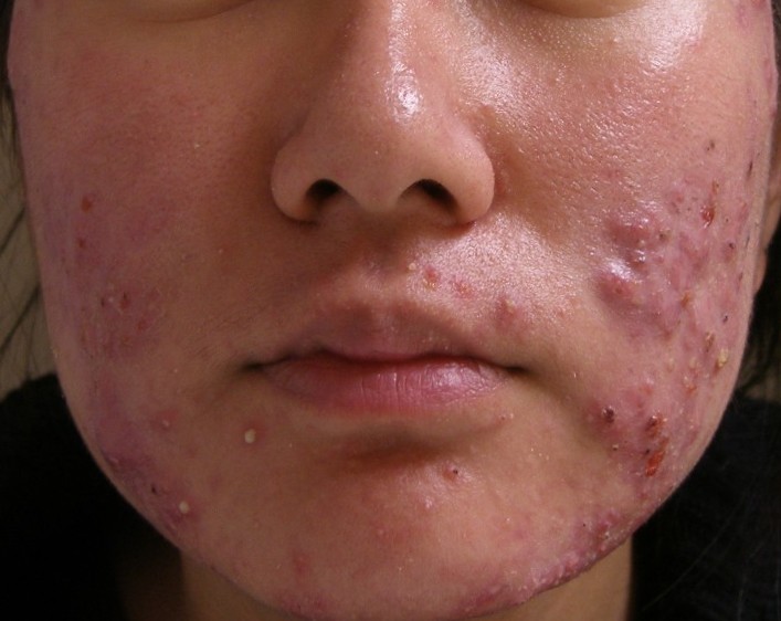 Acne – Dermatology Practice of Roanoke