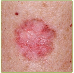 skin cancer treatment in roanoke virgnia