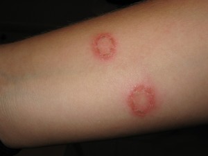 Tinea Corporis (Ringworm) - Online Dermatology