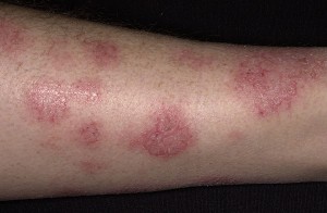 eczema treatment roanoke virginia