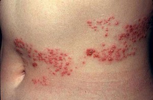 shingles dermatology