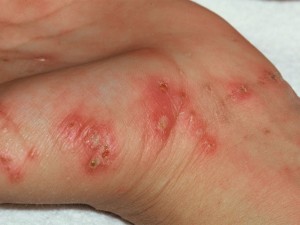 scabies dermatologist in roanoke