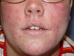 steroid rosacea